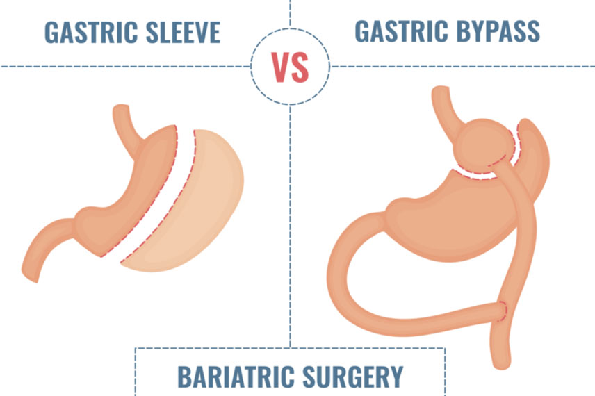 مقایسه نحوه انجام جراحی اسلیو معده و بای پس معده